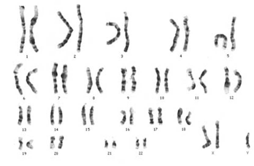 <p>Write down the condition this person has (if they do), and their karyotype notation:</p>