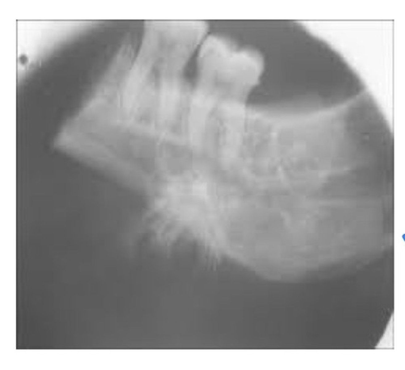 <p>A malignant tumour of bone forming tissue. Most common primary malignant tumour of bone in patients less than 40 yrs of age. Occurs twice as frequently in mandible as maxilla. More common in males. Radiographically: asymmetric widening of the PDL space, and a "sunburst" pattern may be seen.</p>