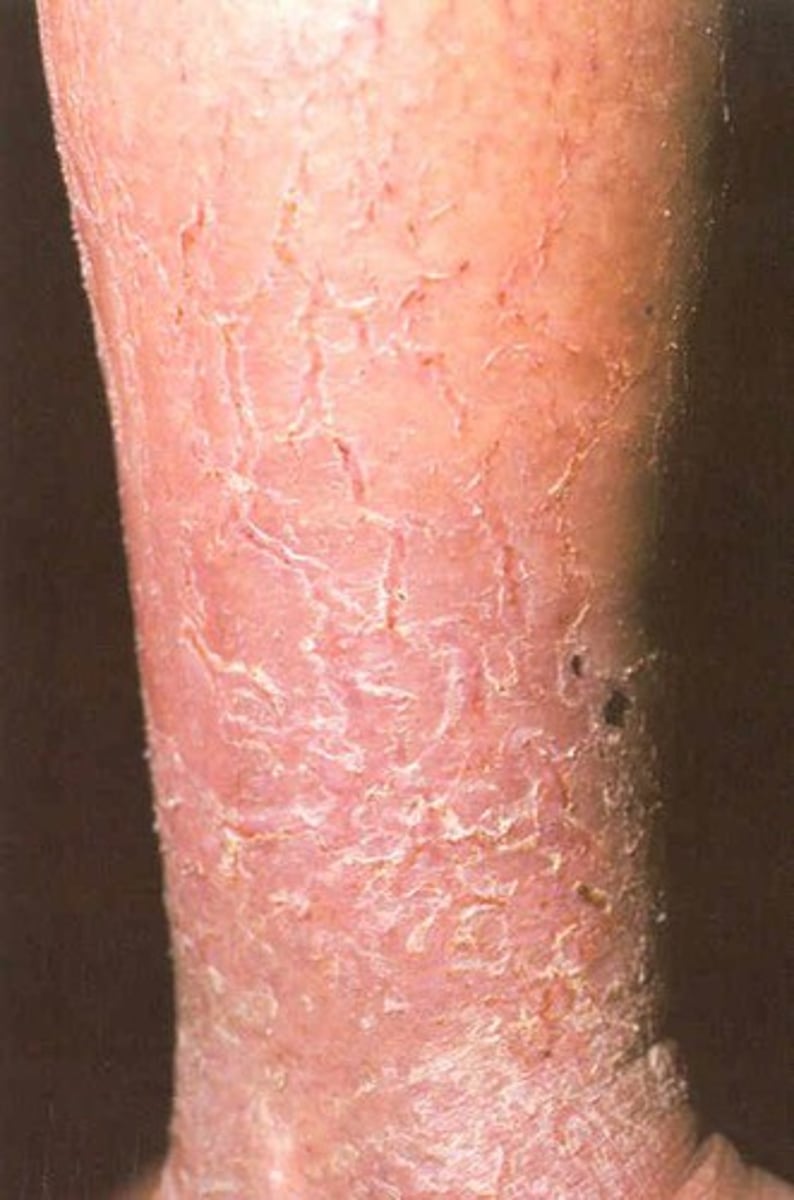 <p>compact, flakes of skin, dry or greasy, silvery or white, caused by shedding or dead skin cells</p>