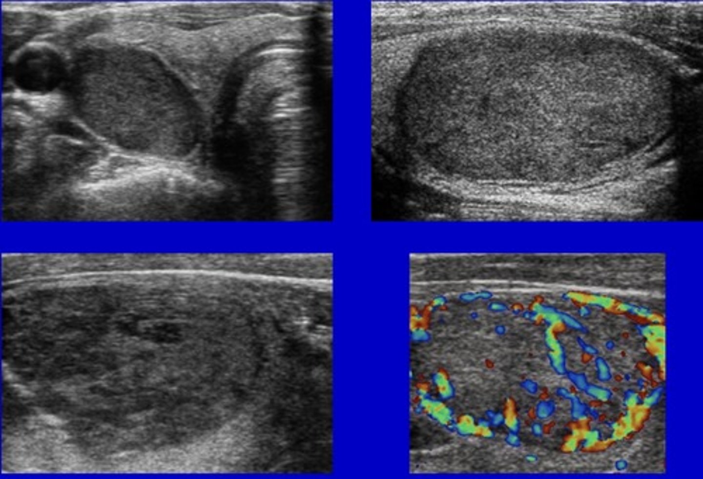 <p>2nd most common type of thyroid carcinoma</p><p>Slow-growing</p><p>Metastases to bone, lung, liver</p>