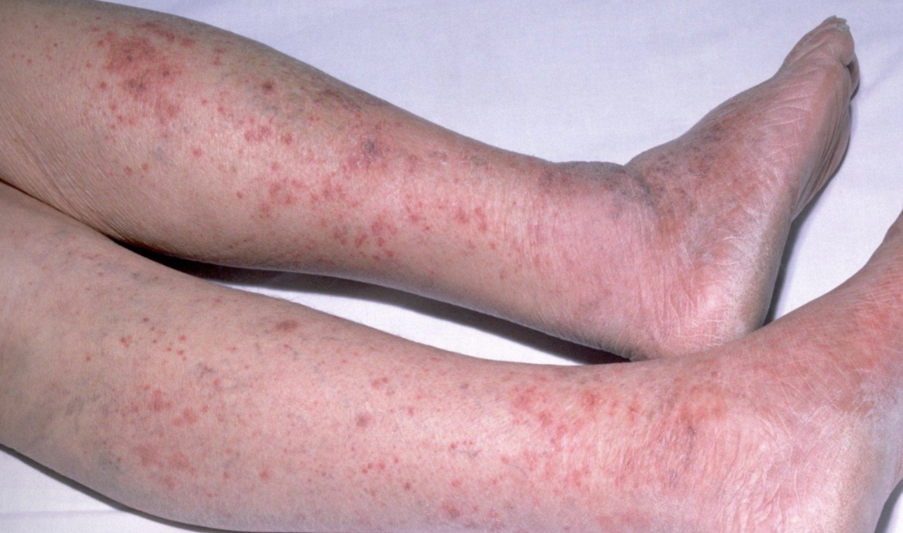 <p>Usually starts <mark data-color="yellow" style="background-color: yellow; color: inherit;">as small, red pinpricks</mark> before <u>spreading quickly</u> and turning into <mark data-color="red" style="background-color: red; color: inherit;">red and purple blotches</mark> </p><p></p>