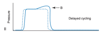 <ul><li><p><span>The patient initiates active expiratory efforts while the ventilator is continuing to deliver inspiratory flow</span></p></li><li><p><span>Manifests as a pressure spike on the pressure scalar during mid to late inspiration</span></p></li><li><p><span>On the flow scalar, shows as an abrupt, rapid decline in inspiratory flow near end-inspiration</span></p></li><li><p><span>Managed by reducing I-time or tidal volumes</span></p></li><li><p><span>Important not to confuse the early plateau change seen with flow asynchrony and the late plateau change seen with delayed cycling because the adjustments needed to address these are very different</span></p></li></ul><p></p>