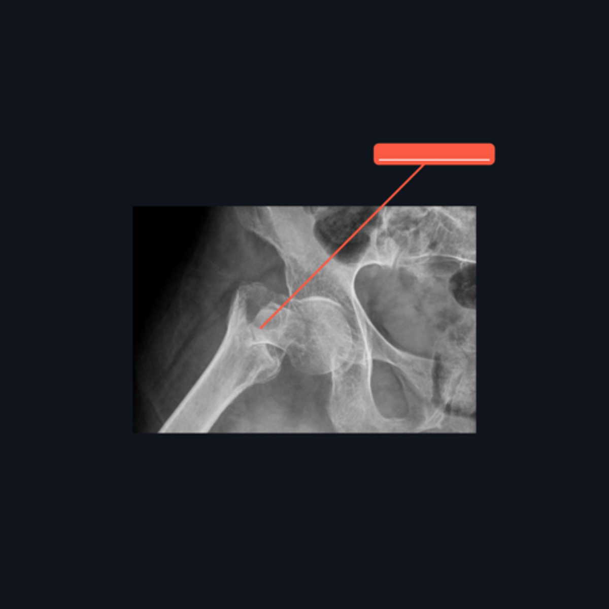<p>Identify the type of fracture.</p>