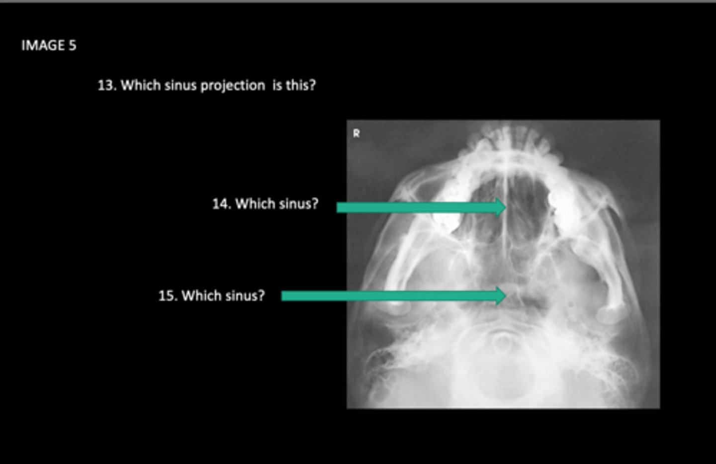 <p>Which sinus is 14 pointing at?</p>