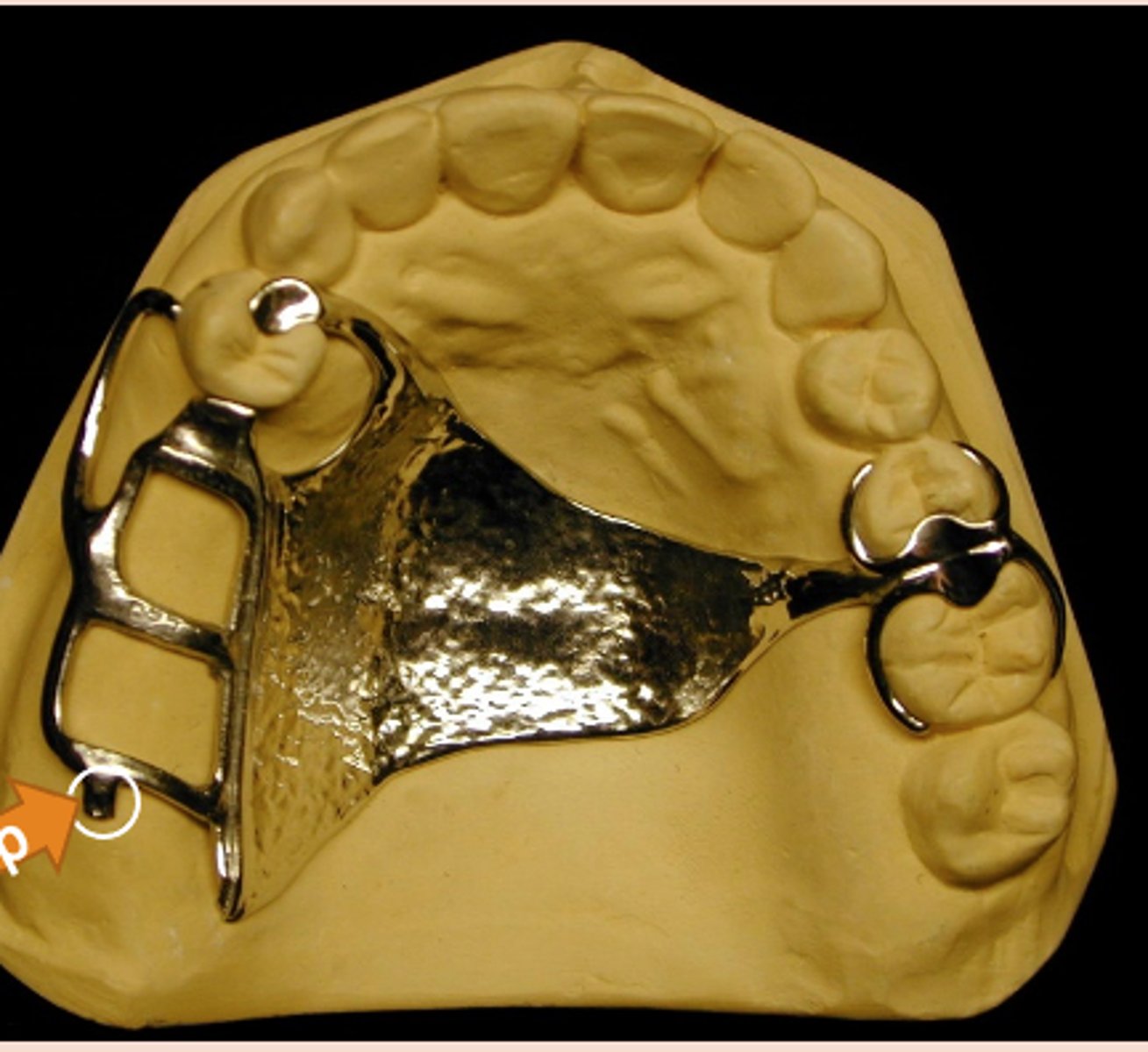 <p>small projection of metal at the distal end of an extension base framework that contacts the cast and prevents downward movement of the acrylic retention area during the processing of the RPD for delivery</p>