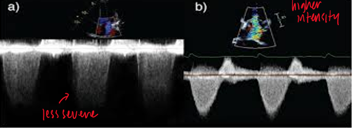 <p>signal intensity relative to antegrade flow</p><p>antegrade flow velocity</p><p>shape of velocity curve</p>