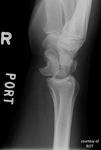 <p>What does a 'spilled teacup' appearance indicate on lateral wrist imaging?</p>