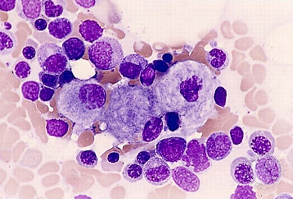 <p>What condition is a lipid storage disorder of macrophages caused by a deficiency of <strong>glucocerebrosidase</strong>?</p>
