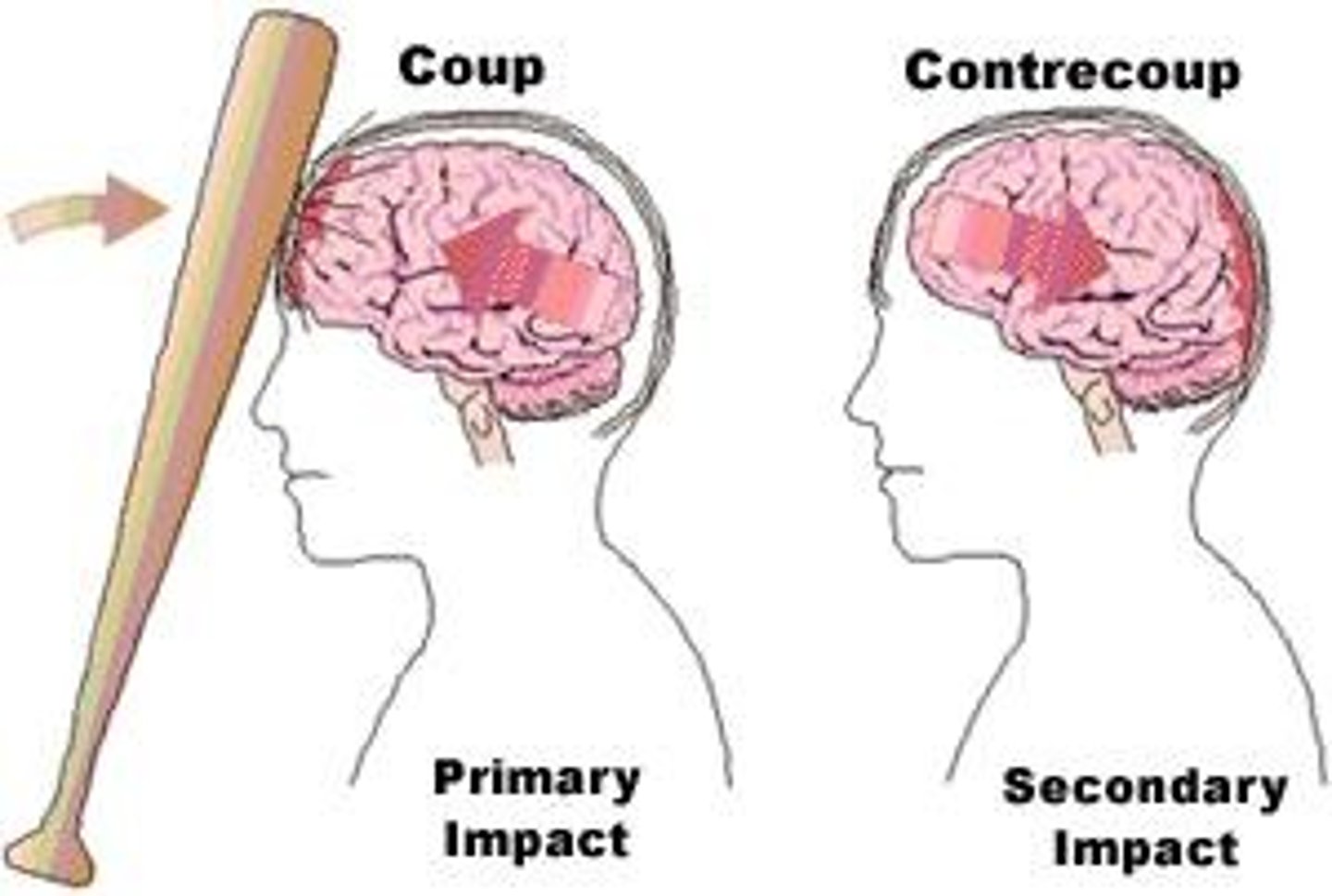 <p>Coup refers to the brain injury at the site of impact, while contrecoup refers to injury on the opposite side of the brain.</p>