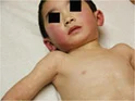 <p>Erythema Infectiosum (Fifth Disease)</p>