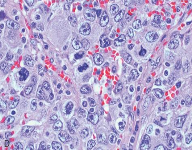 <p>Carcinoma de células grandes, microscopia</p>