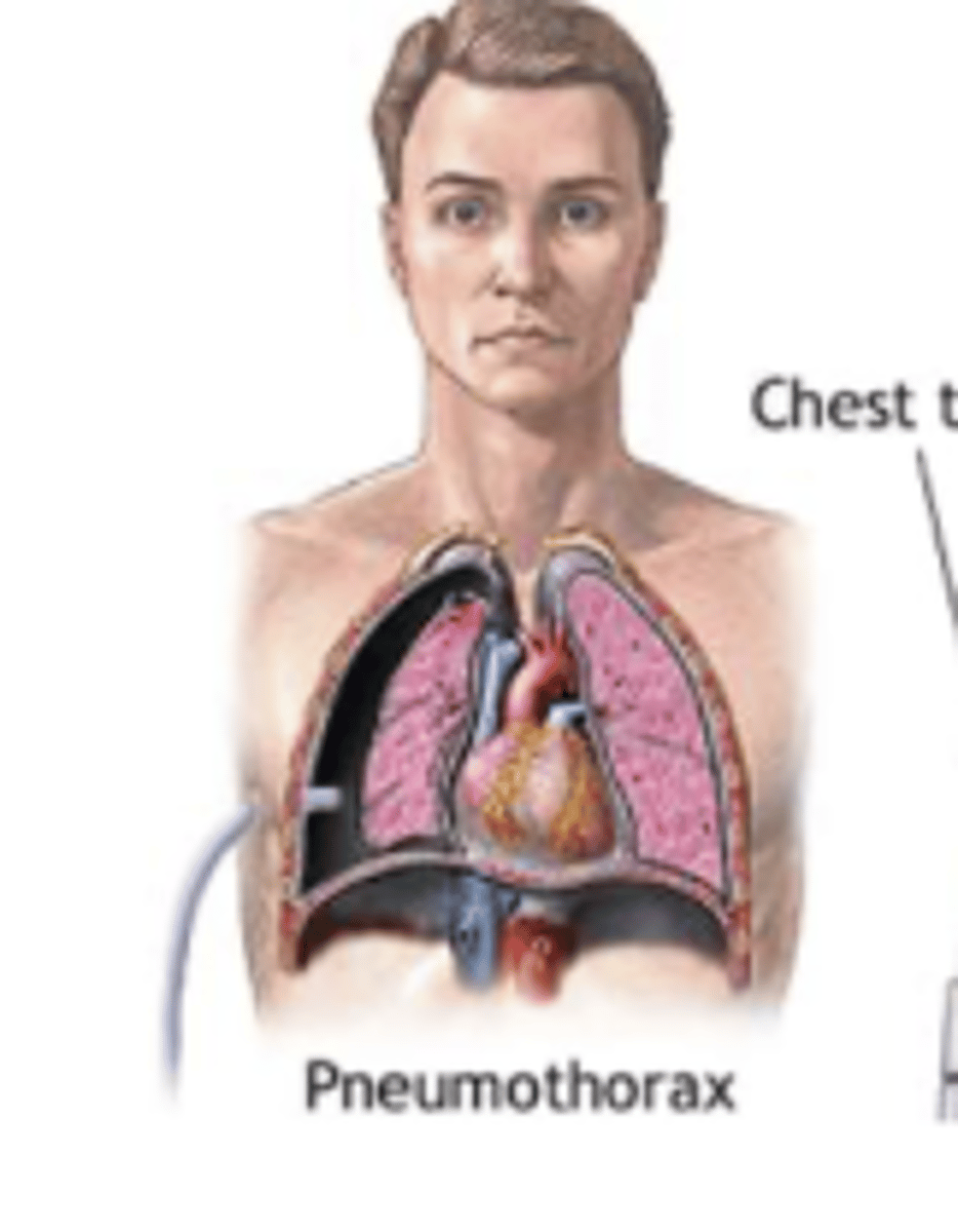 <p>chest tube with oneway valve for air aspiration</p>