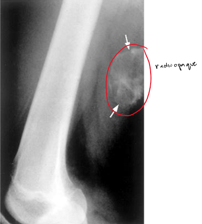 <p><strong><mark data-color="blue">ossification of injured muscles</mark></strong> usually caused by trauma</p><ul><li><p>may be mistaken for malignancy</p></li><li><p>feels hard/firm </p></li></ul>