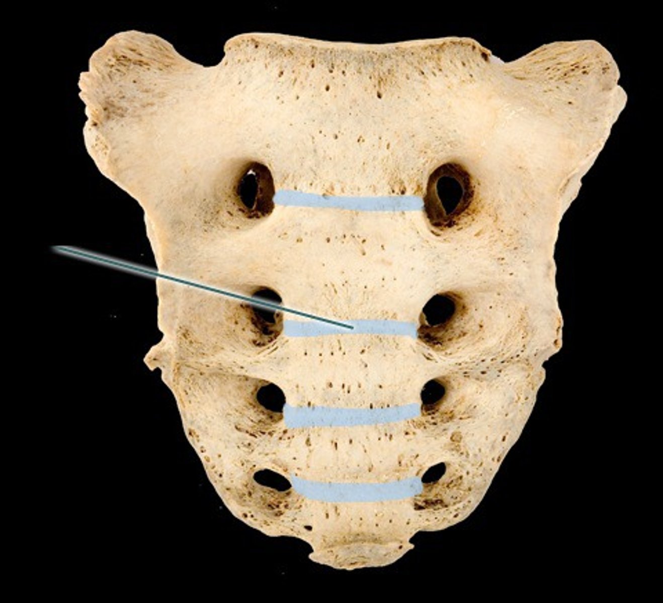 <p>site of vertebral fusion</p>