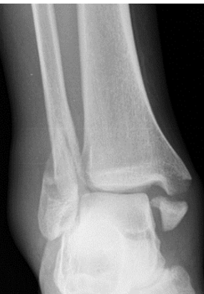 <p>Fracture of ankle joint involving medial and lateral malleoli and posterior lip of distal tibia</p>