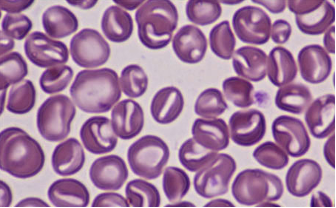 <p>slit-like central pallor</p>