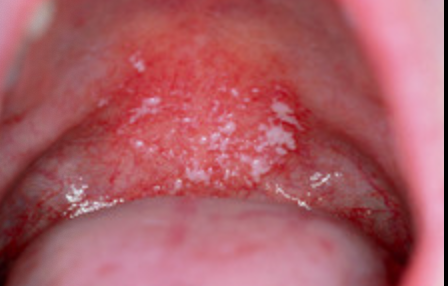 <p>1b.What would be the most likely cause of the white lesion?</p>