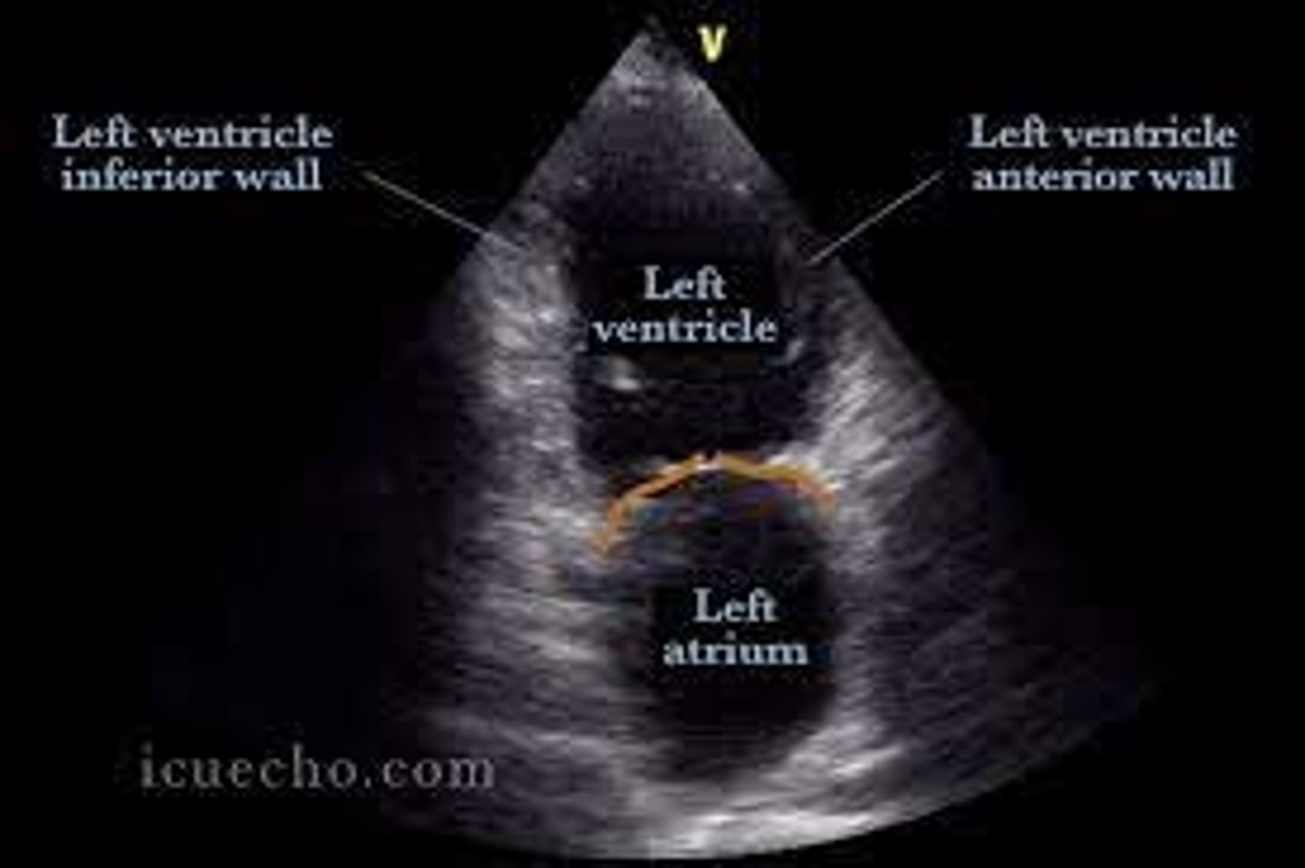 <p>anterior mitral valve leaflet</p>
