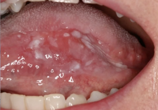 <p>What is the management of this lesion?</p>
