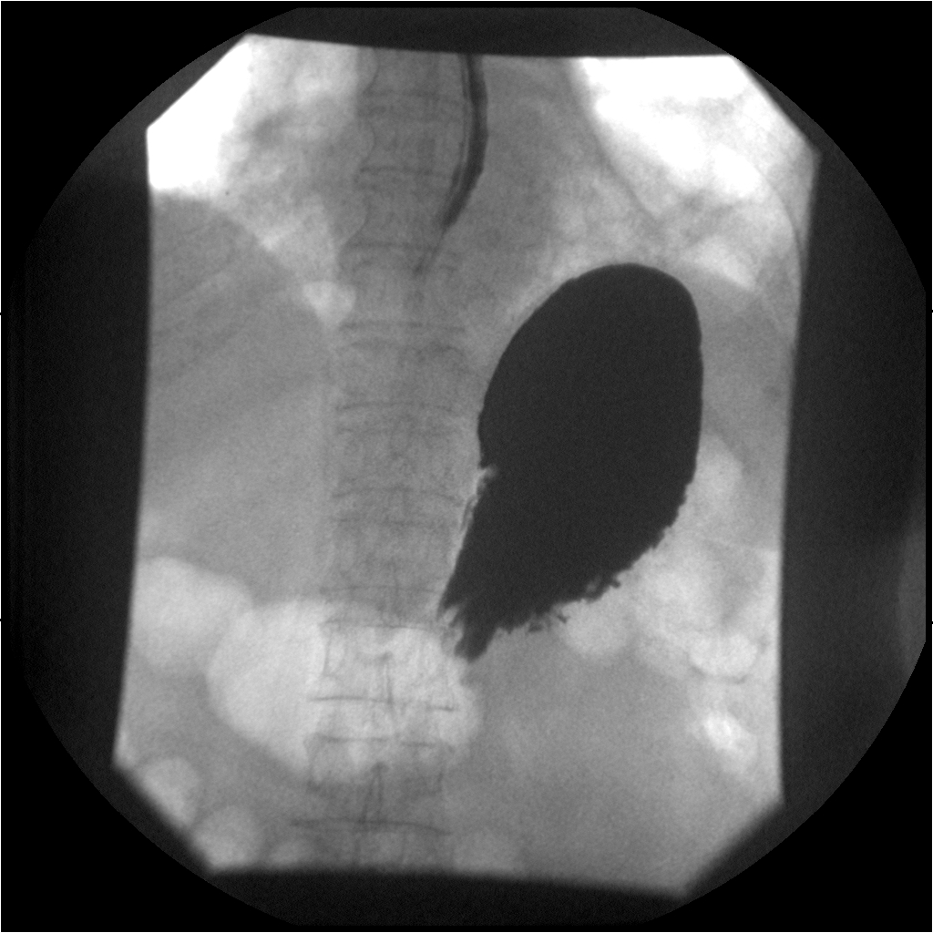 <p>What is the radiographic appearance of infiltrative gastric carcinoma?</p>