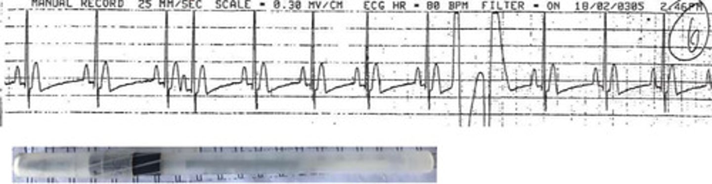 <p>What arrhythmias are shown?</p>