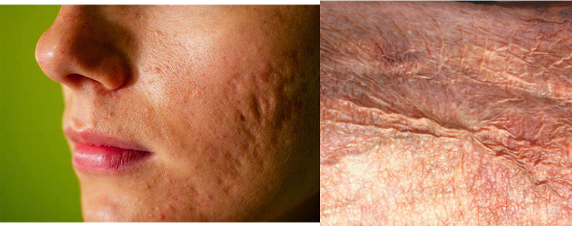 <p>depression of skin caused by thinning of epidermis or dermis</p>