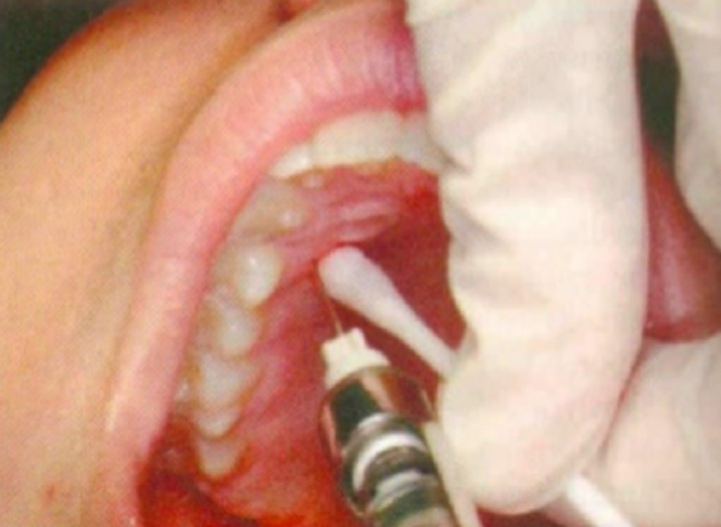 <p>ID the anesthesia technique:</p>