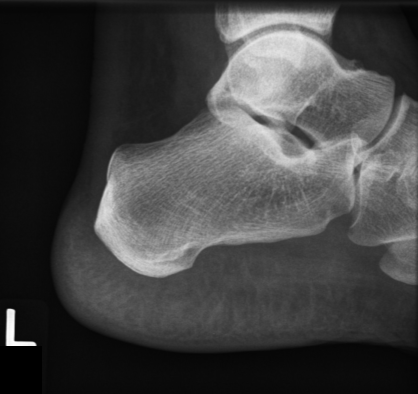 <ul><li><p><mark data-color="yellow" style="background-color: yellow; color: inherit">ankle joint</mark></p></li><li><p>talus and calcaneus</p></li><li><p>calc-cuboid joint (<mark data-color="yellow" style="background-color: yellow; color: inherit">adj tarsal bones</mark>)</p></li><li><p>ST</p></li></ul><p></p>