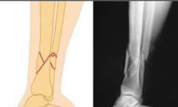 <p>What type of fracture is this?</p>