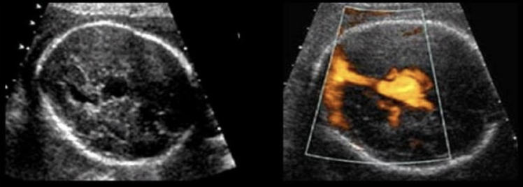<p>this is ___ and it’s assoc w/</p><p>a) vein of galen aneurysm, congestive heart failure</p><p>b) dilated 3rd ventricle, spina bifida</p><p>c) agenesis of corpus callosum, triploidy</p><p>d) middle cerebral artery aneurysm, fetal demise </p>