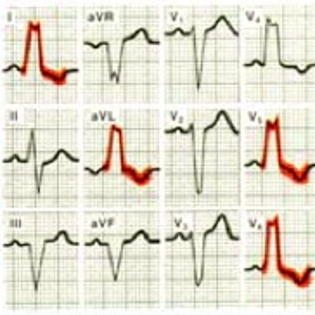 <p>- wide QRS &gt;3 boxes (0.12)</p><p>- V5/V6 "bunny ears" (2-R waves)</p><p>(V1/2/3 all down)</p><p>- not as common, more patho</p>