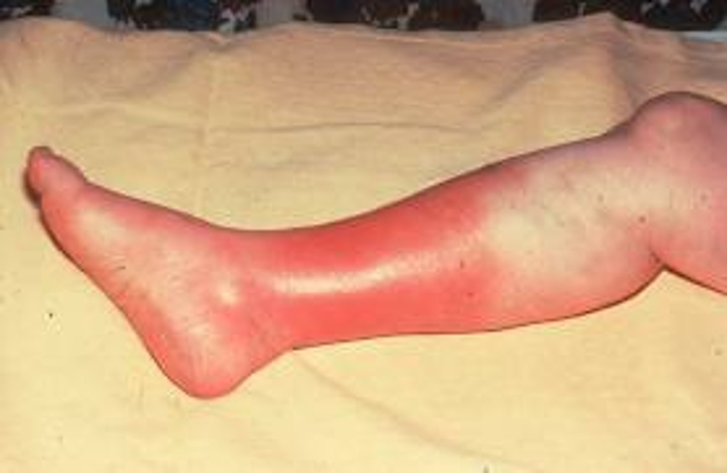 <p>a common, potentially serious bacterial skin infection. The affected skin is swollen and inflamed and is typically painful and warm to the touch</p>