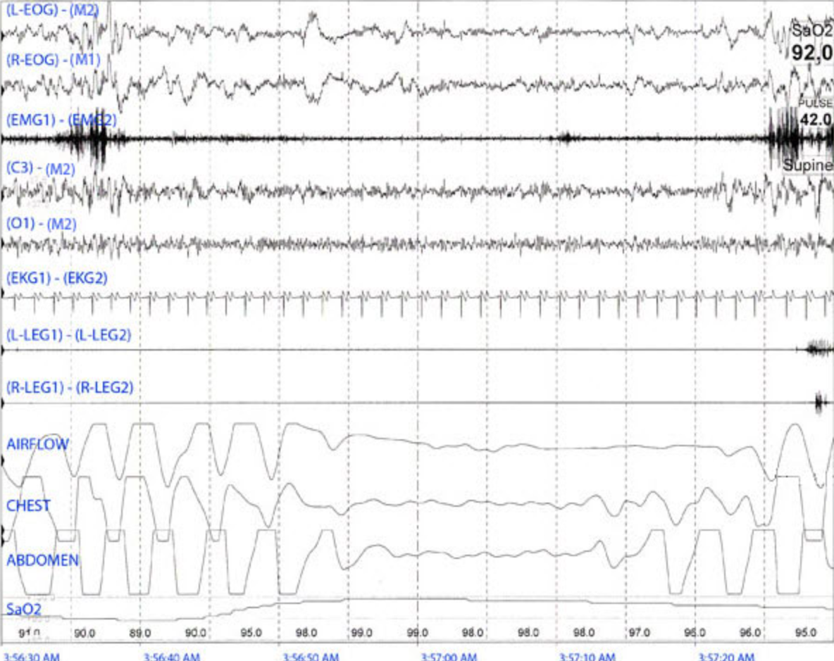 <p>The following 60-second tracing is observed while scoring study results for an adult patient. Which of the following types of apneas best describes the event in this tracing?</p>