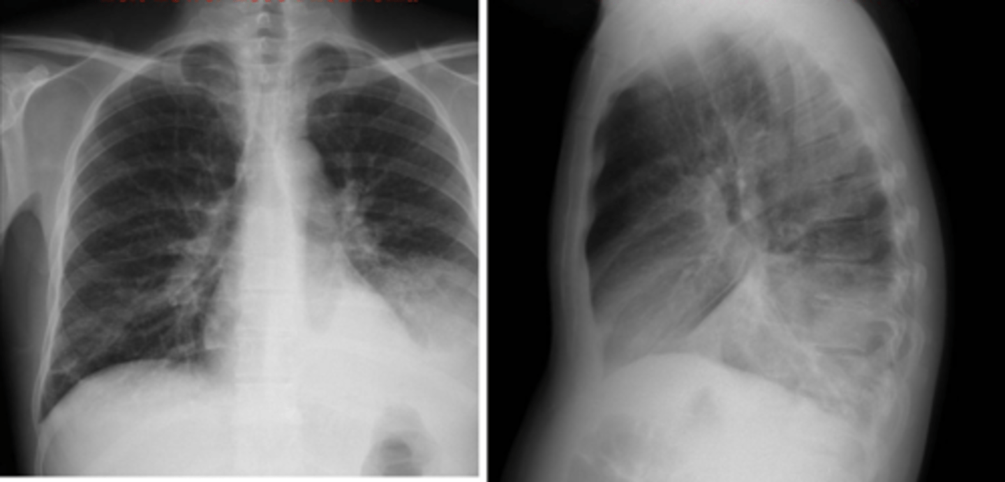 <p>left lower lobe pneumonia</p>