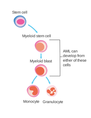 <p>Akut myeloisk leukemi (vanligast leukemin hos vuxna). 15% får det sekundärt till MDS eller MPS. <em>Etiologi</em> <em>ofta okänd</em>.</p><p>Det är en ohämmad proliferation av myeloiska blaster i benmärgen → <strong>benmärgssvikt</strong> när andra cellinjer trycks bort. Inga myeloiska blaster kan mogna fullständigt och det leder ofta till anemi, trombocytopeni och granulocytopeni.</p><p>Sympom är viktminskning, trötthet, feber och infektionstendens. Det är benmärgssvikten som är det farliga.</p>