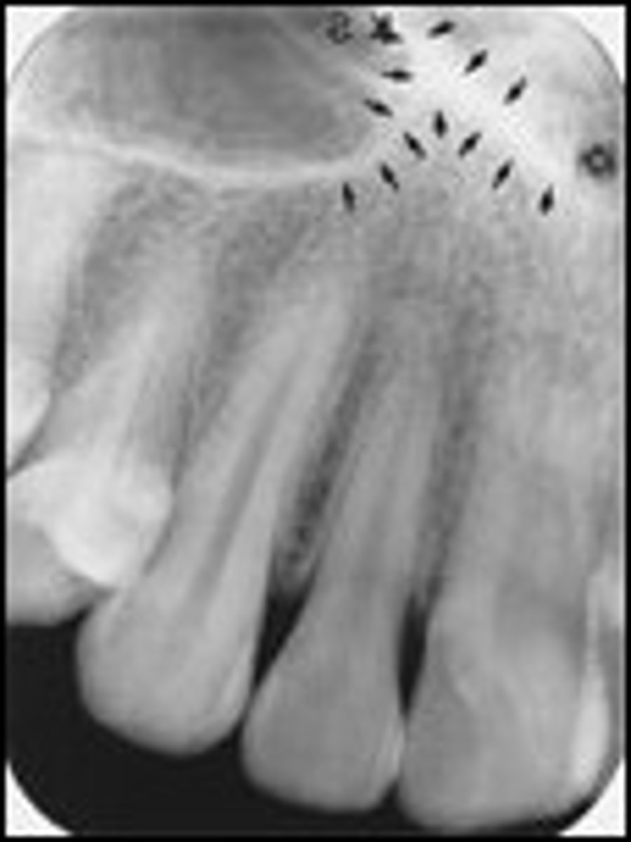 <p>The intersection of the maxillary sinus and the nasal cavity</p><p>located above maxillary canines</p>