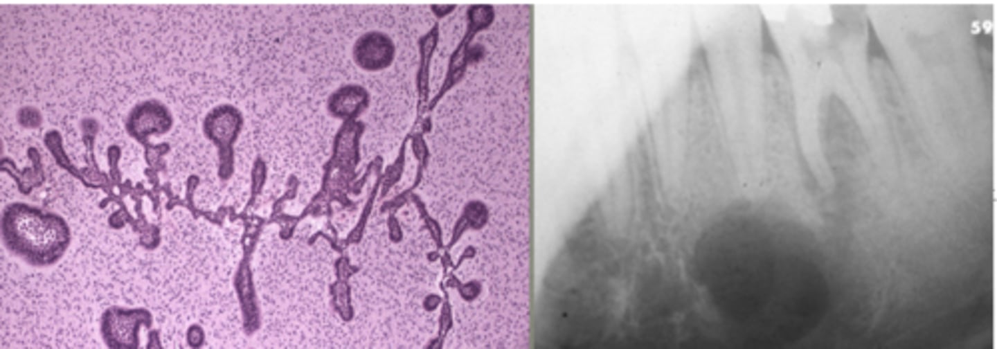 <p>painless swelling, circumscribed radiolucency, and a pulp-like stroma with islands of ameloblastic epithelium </p><p>45% of them are recurrent, so important to excise well </p>