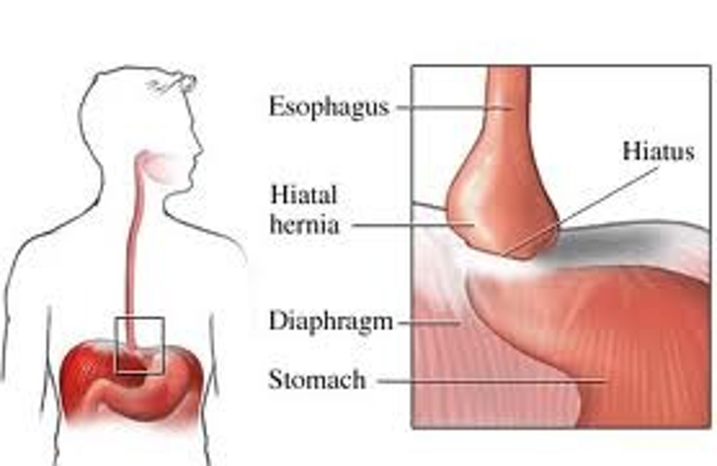 <p>B. CORRECT. A hiatal hernia occurs when the part of the top of the stomach protrudes through the diaphragm. Risk factors of a hiatal hernia include middle age and obesity.</p><p>A. An umbilical hernia occurs when part of the bowel protrudes through the abdominal muscle wall.</p><p>C. An inguinal hernia occurs when a portion of the bowel protrudes into the inguinal canal.</p><p>D. An incisional hernia occurs when tissue protrudes at a surgical site.</p>