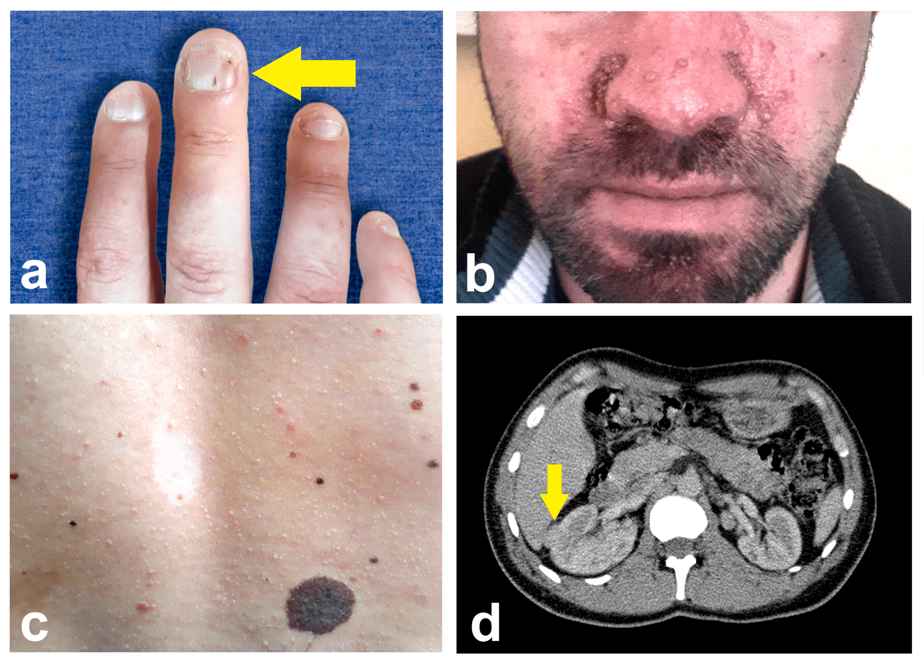 TUBERO SCLEROSIS