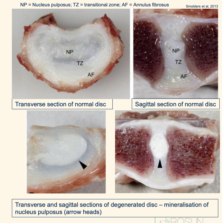 <ol><li><p><strong>Chondroid metaplasia </strong></p><ul><li><p>nucleus pulposus and then the annulus fibrosis</p></li><li><p>notocordal cells (NP) and spindle shaped fibroblasts (AF) replaced by <strong><u>chondrocytes</u></strong></p></li></ul></li><li><p><strong>Dehydration of nucleus pulposus</strong></p><ul><li><p>loss of glycosaminoglycan from NP</p></li></ul></li><li><p><strong>Fissures in annulus fibrosus</strong></p><ul><li><p>tears and clefts form in AF, most commonly dorsal or dorsolateral regions</p></li></ul></li><li><p><strong>Necrosis and secondary calcification</strong></p><ul><li><p>mainly NP periphery and occasionally in AF</p></li></ul></li></ol><p></p>