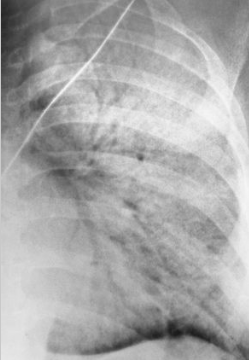 <p>Describe the RA for alveolar pneumonia (this pic and pic in description)</p>