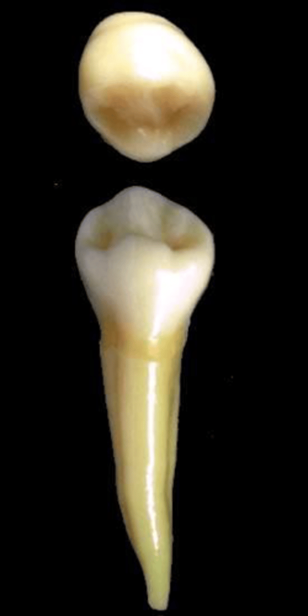 <p>what tooth is this &amp; why?</p>