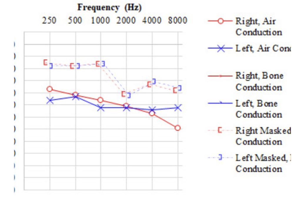 <p>What does this audiogram show?</p>