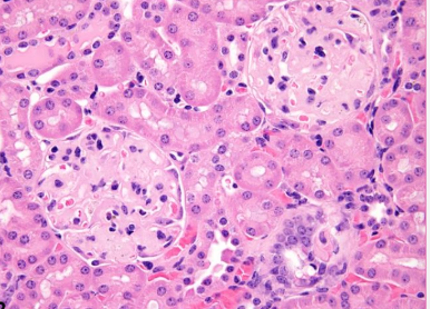 <p>Amyloid AA- most common in vet med</p><p>has classical locations in renal glomeruli, liver, and spleen</p>