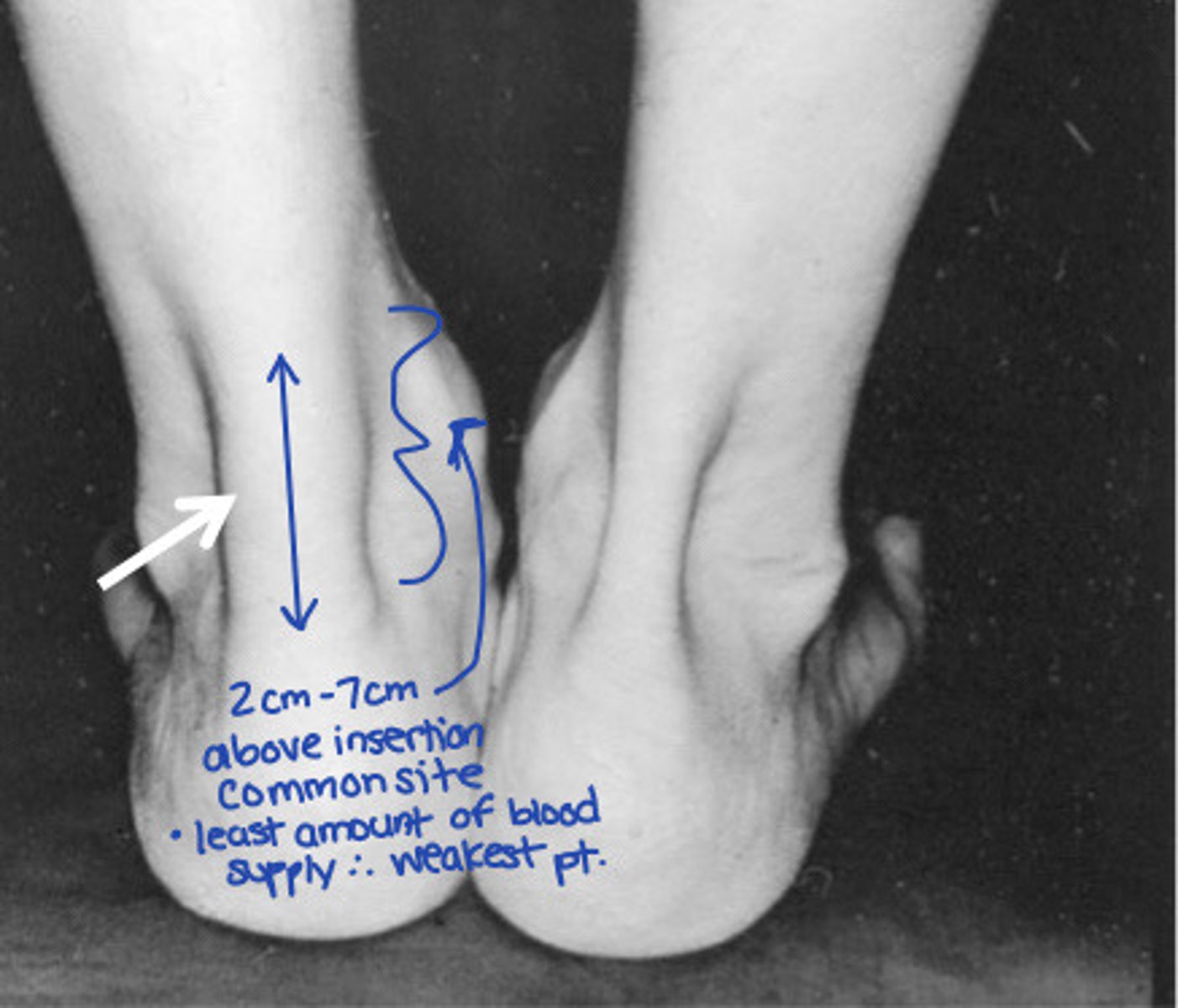 <p>Increased tendon thickness (remember: INCREASED vascularity &amp; neuronal growth w/ ABSENCE of inflammatory cells)</p>