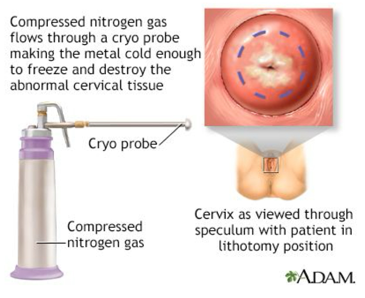 <ul><li><p>of the cervix</p></li><li><p>uses extremely cold chemicals (liquid nitrogen) to destroy suspicious cells or tissue in a woman’s cervix</p></li></ul><p></p>