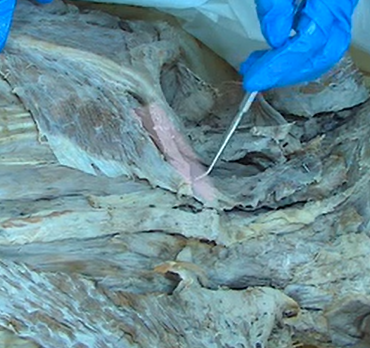 <p>A muscle that originates on the spinous process of T1, inserts on the scapula, and functions similarly to the rhomboid major.</p>
