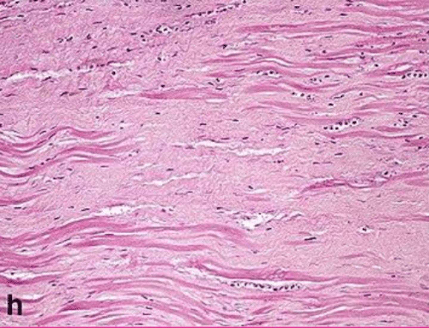 <p>Describe this extracellular accumulation (heart muscle)</p>