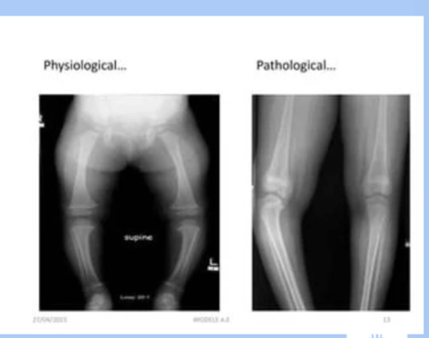 <p>-varum: excessive varus angulation at knee (bowleg) </p><p>-0-3yr: varum is normal</p><p>-pathologic: blounts disease (tibal rotation), obesity, early walking, genetics</p><p>-referral in persist beyond 2, bowing increases, only in one leg </p>