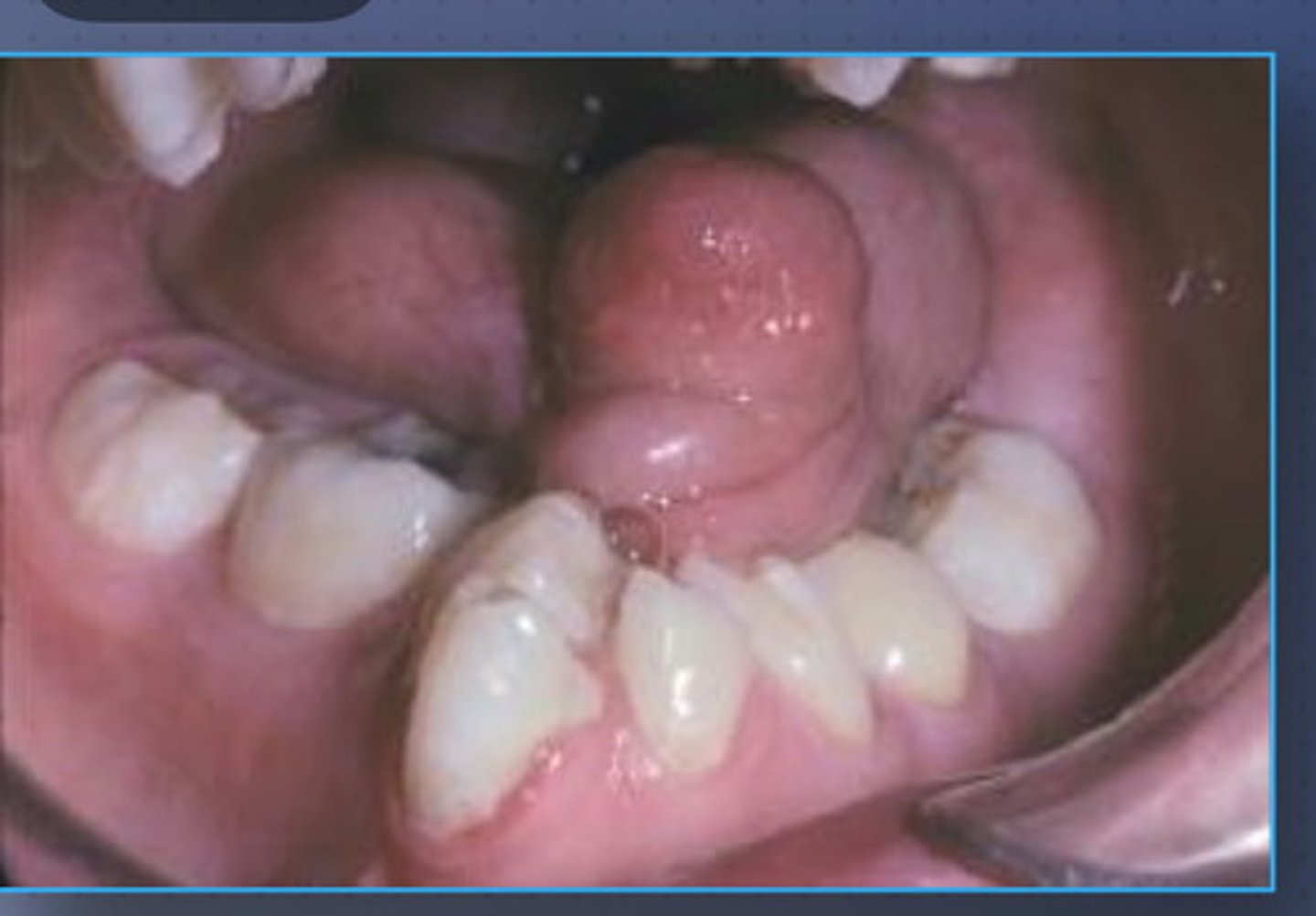 <p>• Uncommon developmental</p><p>condition of unknown cause that</p><p>is characterized by an</p><p>abnormally small tongue</p><p>• May be isolated or part of a</p><p>syndrome</p>